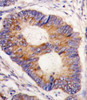 Formalin-fixed and paraffin-embedded human colon carcinoma tissue reacted with FXN antibody, which was peroxidase-conjugated to the secondary antibody, followed by DAB staining.