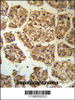 BLNK Antibody IHC analysis in formalin fixed and paraffin embedded human hepatocarcinoma followed by peroxidase conjugation of the secondary antibody and DAB staining.