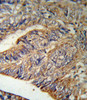 IL1RN Antibody (RB18901) IHC analysis in formalin fixed and paraffin embedded human Colon carcinoma followed by peroxidase conjugation of the secondary antibody and DAB staining.