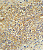 UDB17 Antibody IHC analysis in formalin fixed and paraffin embedded human Prostate carcinoma followed by peroxidase conjugation of the secondary antibody and DAB staining.