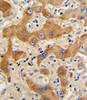 Formalin-fixed and paraffin-embedded human hepatocarcinoma reacted with GCG Antibody (N-term) , which was peroxidase-conjugated to the secondary antibody, followed by DAB staining.