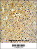 P450R Antibody IHC analysis in formalin fixed and paraffin embedded human hepatocarcinoma tissue followed by peroxidase conjugation of the secondary antibody and DAB staining.