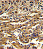 Formalin-fixed and paraffin-embedded human hepatocarcinoma reacted with ABCG1 Antibody, which was peroxidase-conjugated to the secondary antibody, followed by DAB staining.