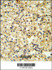 TRAP Antibody IHC analysis in formalin fixed and paraffin embedded kidney carcinoma followed by peroxidase conjugation of the secondary antibody and DAB staining.