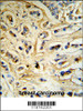 CASA Antibody (RB18742) IHC analysis in formalin fixed and paraffin embedded human breast carcinoma tissue followed by peroxidase conjugation of the secondary antibody and DAB staining.