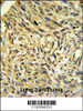 FKBP14 Antibody IHC analysis in formalin fixed and paraffin embedded human Lung carcinoma followed by peroxidase conjugation of the secondary antibody and DAB staining.