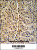 GNS Antibody (Center S298) IHC analysis in formalin fixed and paraffin embedded human hepatocarcinoma followed by peroxidase conjugation of the secondary antibody and DAB staining.