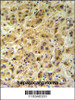 GNS Antibody (Center N189) IHC analysis in formalin fixed and paraffin embedded human hepatocarcinoma followed by peroxidase conjugation of the secondary antibody and DAB staining.