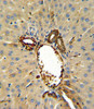 Annexin V Antibody IHC analysis in formalin fixed and paraffin embedded human hepatocarcinoma followed by peroxidase conjugation of the secondary antibody and DAB staining.