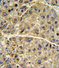 Formalin-fixed and paraffin-embedded human hepatocarcinoma with COL6A1 Antibody (N-term) , which was peroxidase-conjugated to the secondary antibody, followed by DAB staining.