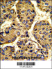 Formalin-fixed and paraffin-embedded human hepatocarcinoma with ASPN Antibody, which was peroxidase-conjugated to the secondary antibody, followed by DAB staining.