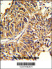 Formalin-fixed and paraffin-embedded human lung carcinoma reacted with HMGCS1 Antibody, which was peroxidase-conjugated to the secondary antibody, followed by DAB staining.