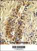 Formalin-fixed and paraffin-embedded human lung carcinoma reacted with TALDO1 Antibody, which was peroxidase-conjugated to the secondary antibody, followed by DAB staining.