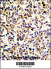 Formalin-fixed and paraffin-embedded human kidney carcinoma with KRT10 Antibody (N-term) , which was peroxidase-conjugated to the secondary antibody, followed by DAB staining.