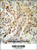 KRT13 Antibody (RB18903) IHC analysis in formalin fixed and paraffin embedded human breast carcinoma followed by peroxidase conjugation of the secondary antibody and DAB staining.