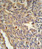 GLA Antibody IHC analysis in formalin fixed and paraffin embedded human Lung carcinoma followed by peroxidase conjugation of the secondary antibody and DAB staining.