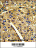 Formalin-fixed and paraffin-embedded human hepatocarcinoma reacted with AMT Antibody (N-term) , which was peroxidase-conjugated to the secondary antibody, followed by DAB staining.