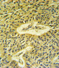 Smad7 Antibody IHC analysis in formalin fixed and paraffin embedded lung carcinoma followed by peroxidase conjugation of the secondary antibody and DAB staining.