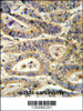 Formalin-fixed and paraffin-embedded human colon carcinoma reacted with IGFBP6 Antibody, which was peroxidase-conjugated to the secondary antibody, followed by DAB staining.