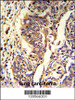 Formalin-fixed and paraffin-embedded human lung carcinoma reacted with KYNU Antibody, which was peroxidase-conjugated to the secondary antibody, followed by DAB staining.