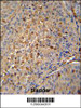 MAPRE1 antibody immunohistochemistry analysis in formalin fixed and paraffin embedded human bladder carcinoma followed by peroxidase conjugation of the secondary antibody and DAB staining.