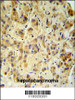 FUCA1 Antibody IHC analysis in formalin fixed and paraffin embedded human hepatocarcinoma followed by peroxidase conjugation of the secondary antibody and DAB staining.