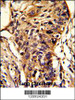 Formalin-fixed and paraffin-embedded human lung carcinoma reacted with BCKDHA Antibody, which was peroxidase-conjugated to the secondary antibody, followed by DAB staining.
