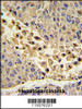 Formalin-fixed and paraffin-embedded human hepatocarcinoma with COLEC11 Antibody (N-term) , which was peroxidase-conjugated to the secondary antibody, followed by DAB staining.