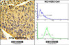 (LEFT) Formalin-fixed and paraffin-embedded human lung carcinoma with EPB41L4B Antibody, which was peroxidase-conjugated to the secondary antibody, followed by DAB staining. (RIGHT) Flow cytometric analysis of NCI-H292 cells using EPB41L4B Antibody (bottom histogram) compared to a negative control cell (top histogram) . FITC-conjugated goat-anti-rabbit secondary antibodies were used for the analysis.