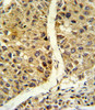 Formalin-fixed and paraffin-embedded human hepatocarcinoma reacted with NOS3 Antibody (N-term) , which was peroxidase-conjugated to the secondary antibody, followed by DAB staining.