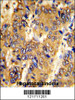 Formalin-fixed and paraffin-embedded human hepatocarcinoma with MSRB2 Antibody, which was peroxidase-conjugated to the secondary antibody, followed by DAB staining.