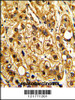 Formalin-fixed and paraffin-embedded human hepatocarcinoma with ITGAX Antibody, which was peroxidase-conjugated to the secondary antibody, followed by DAB staining.