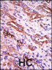 Formalin-fixed and paraffin-embedded human cancer tissue reacted with the primary antibody, which was peroxidase-conjugated to the secondary antibody, followed by DAB staining. BC = breast carcinoma; HC = hepatocarcinoma.