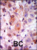 Formalin-fixed and paraffin-embedded human cancer tissue reacted with the primary antibody, which was peroxidase-conjugated to the secondary antibody, followed by AEC staining. BC = breast carcinoma; HC = hepatocarcinoma.