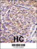 Formalin-fixed and paraffin-embedded human hepatocarcinoma tissue reacted with TAOK3 antibody, which was peroxidase-conjugated to the secondary antibody, followed by DAB staining.