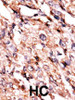 Formalin-fixed and paraffin-embedded human cancer tissue reacted with the primary antibody, which was peroxidase-conjugated to the secondary antibody, followed by AEC staining. BC = breast carcinoma; HC = hepatocarcinoma.