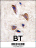 Formalin-fixed and paraffin-embedded human brain tissue reacted with CAMKK2 antibody (Cat.#AP711b) , which was peroxidase-conjugated to the secondary antibody, followed by DAB staining.