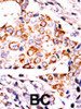 Formalin-fixed and paraffin-embedded human cancer tissue reacted with the primary antibody, which was peroxidase-conjugated to the secondary antibody, followed by DAB staining. BC = breast carcinoma; HC = hepatocarcinoma.