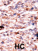 Formalin-fixed and paraffin-embedded human cancer tissue reacted with the primary antibody, which was peroxidase-conjugated to the secondary antibody, followed by AEC staining. BC = breast carcinoma; HC = hepatocarcinoma.