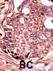 Formalin-fixed and paraffin-embedded human cancer tissue reacted with the primary antibody, which was peroxidase-conjugated to the secondary antibody, followed by DAB staining. BC = breast carcinoma; HC = hepatocarcinoma.