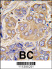 Formalin-fixed and paraffin-embedded human breast carcinoma tissue reacted with HSPB1 Antibody (S78) , which was peroxidase-conjugated to the secondary antibody, followed by DAB staining.