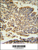 Hsp 27 Antibody IHC analysis in formalin fixed and paraffin embedded human Lung carcinoma followed by peroxidase conjugation of the secondary antibody and DAB staining.