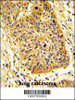 Formalin-fixed and paraffin-embedded human lung carcinoma reacted with RIOK1 Antibody (N-term) , which was peroxidase-conjugated to the secondary antibody, followed by DAB staining.