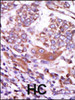 Formalin-fixed and paraffin-embedded human cancer tissue reacted with the primary antibody, which was peroxidase-conjugated to the secondary antibody, followed by AEC staining. BC = breast carcinoma; HC = hepatocarcinoma.