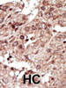 Formalin-fixed and paraffin-embedded human cancer tissue reacted with the primary antibody, which was peroxidase-conjugated to the secondary antibody, followed by AEC staining. BC = breast carcinoma; HC = hepatocarcinoma.