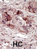 Formalin-fixed and paraffin-embedded human cancer tissue reacted with the primary antibody, which was peroxidase-conjugated to the secondary antibody, followed by DAB staining. BC = breast carcinoma; HC = hepatocarcinoma.