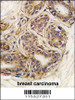 Formalin-fixed and paraffin-embedded human breast carcinoma tissue reacted with CASC3 Antibody (Y181) , which was peroxidase-conjugated to the secondary antibody, followed by DAB staining.