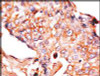 Formalin-fixed and paraffin-embedded human breast carcinoma reacted with anti-NP1 (Nptx1) Antibody, which was peroxidase-conjugated to the secondary antibody, followed by DAB staining.
