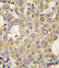 Formalin-fixed and paraffin-embedded human breast carcinoma tissue reacted with Parg antibody, which was peroxidase-conjugated to the secondary antibody, followed by DAB staining.