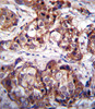 DDR1 Antibody immunohistochemistry analysis in formalin fixed and paraffin embedded human breast carcinoma followed by peroxidase conjugation of the secondary antibody and DAB staining.